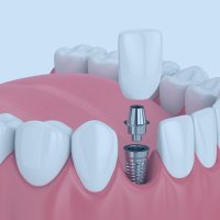 Implantología dental en Menorca